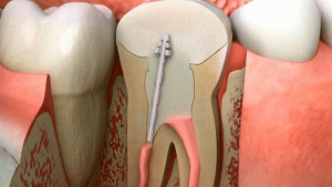 Root Canal Cavity Treatment