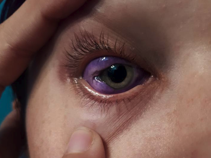 Model discovers that getting an eyeball tattoo is just as stupid and  dangerous as it sounds