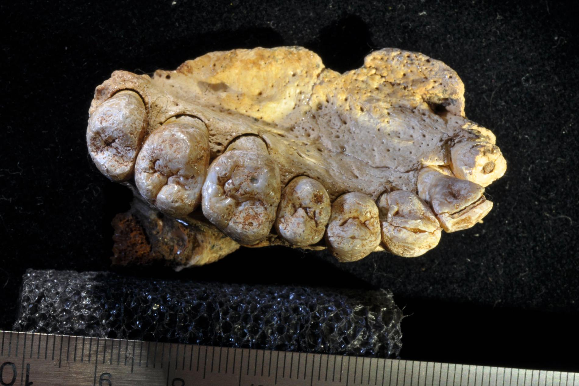  A fossilized human jawbone with teeth, discovered in 2016 in a cave in southern China, is providing new insights into the evolution of hepatitis B virus (HBV).