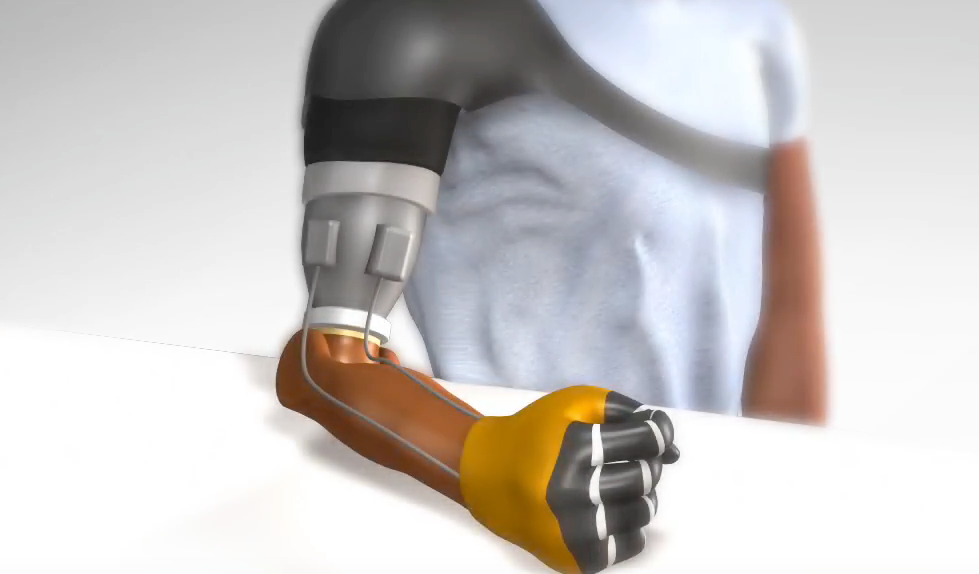 prosthetics