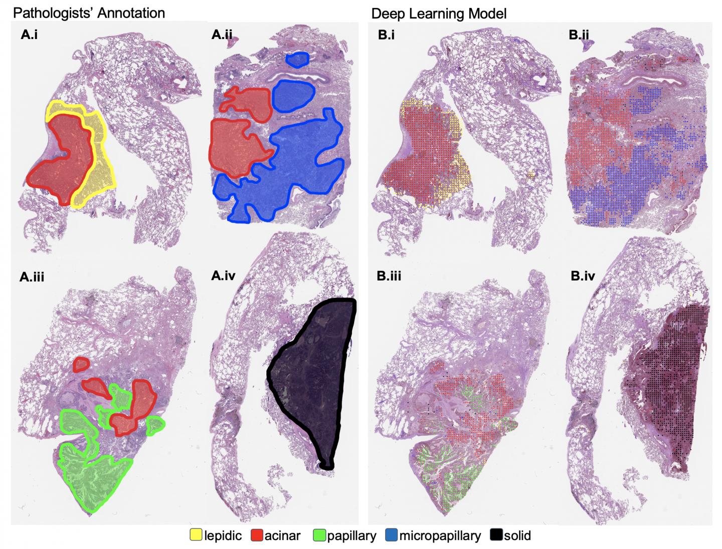 cancer detection using machine learning research paper