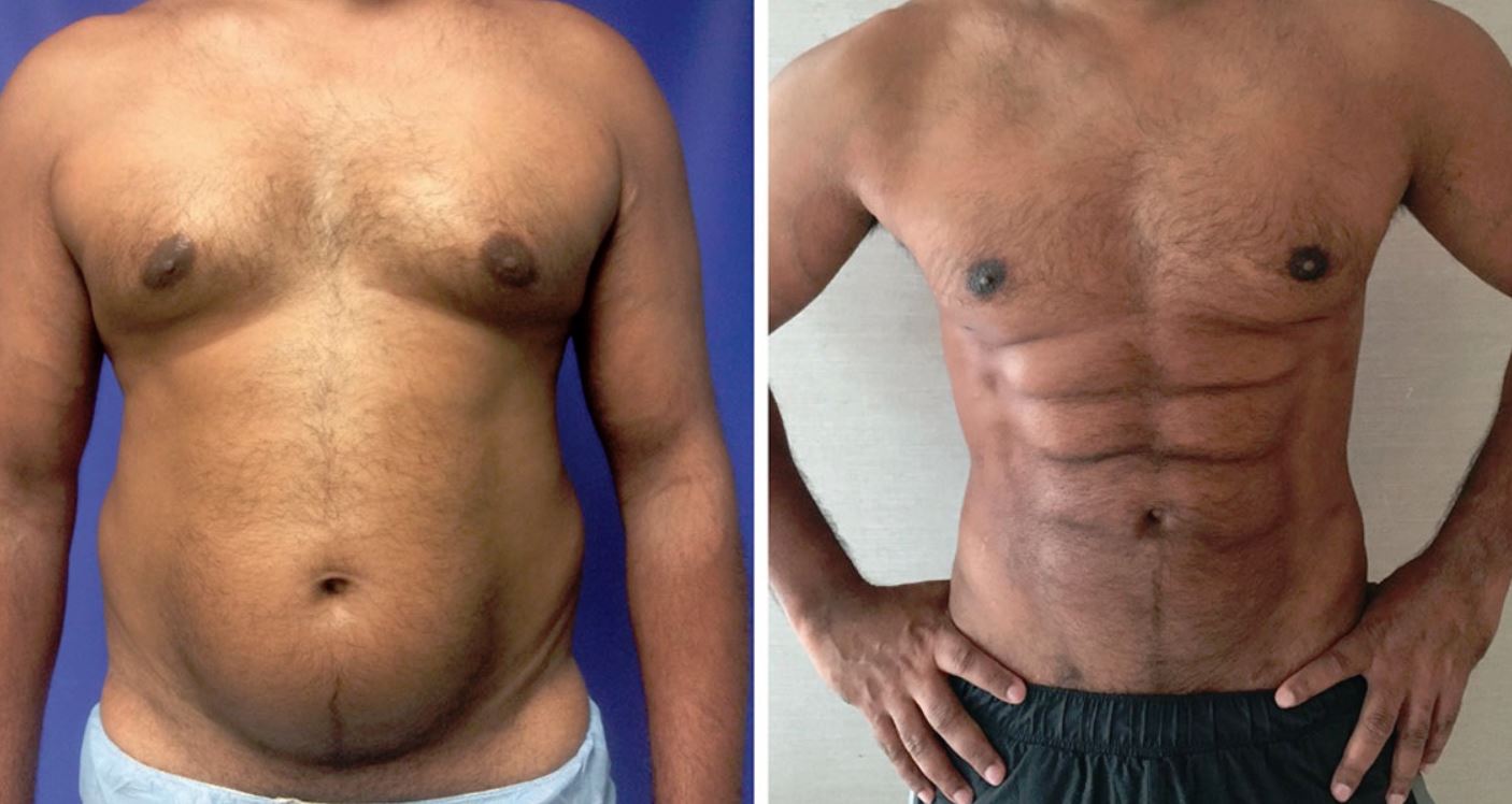 New Plastic Surgery Technique Makes Belly Fat Look Like Chiseled Abs Bgr