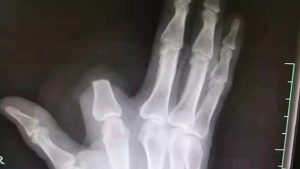 man cuts off finger man cuts off finger