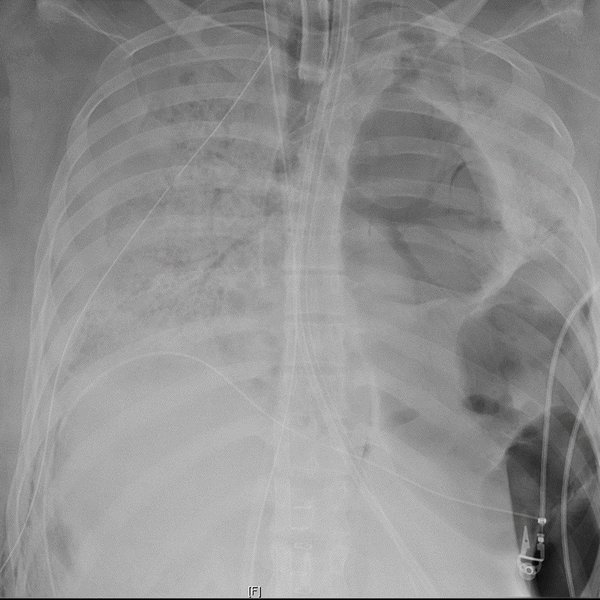 Coronavirus Lung Damage