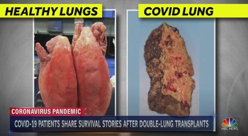 Coronavirus Lung Transplant