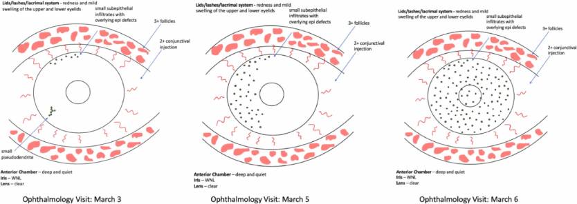 Coronavirus Red Eye