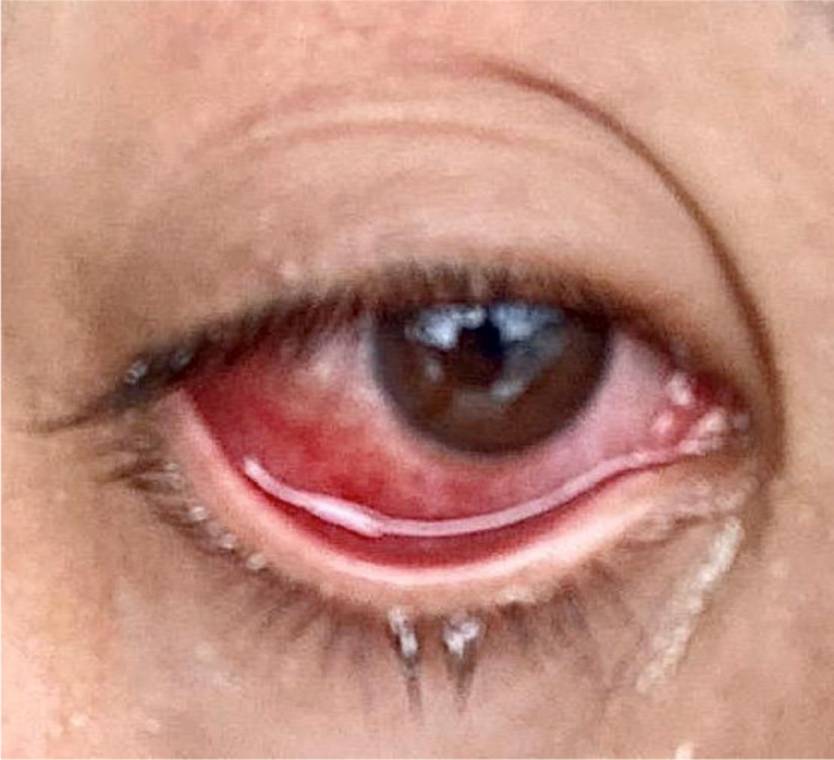 Coronavirus Red Eye