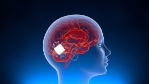 Neuralink surgically implanted computer components onto the surface of a brain