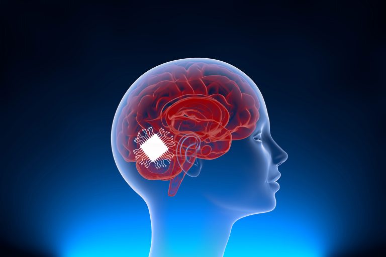 Neuralink surgically implanted computer components onto the surface of a brain