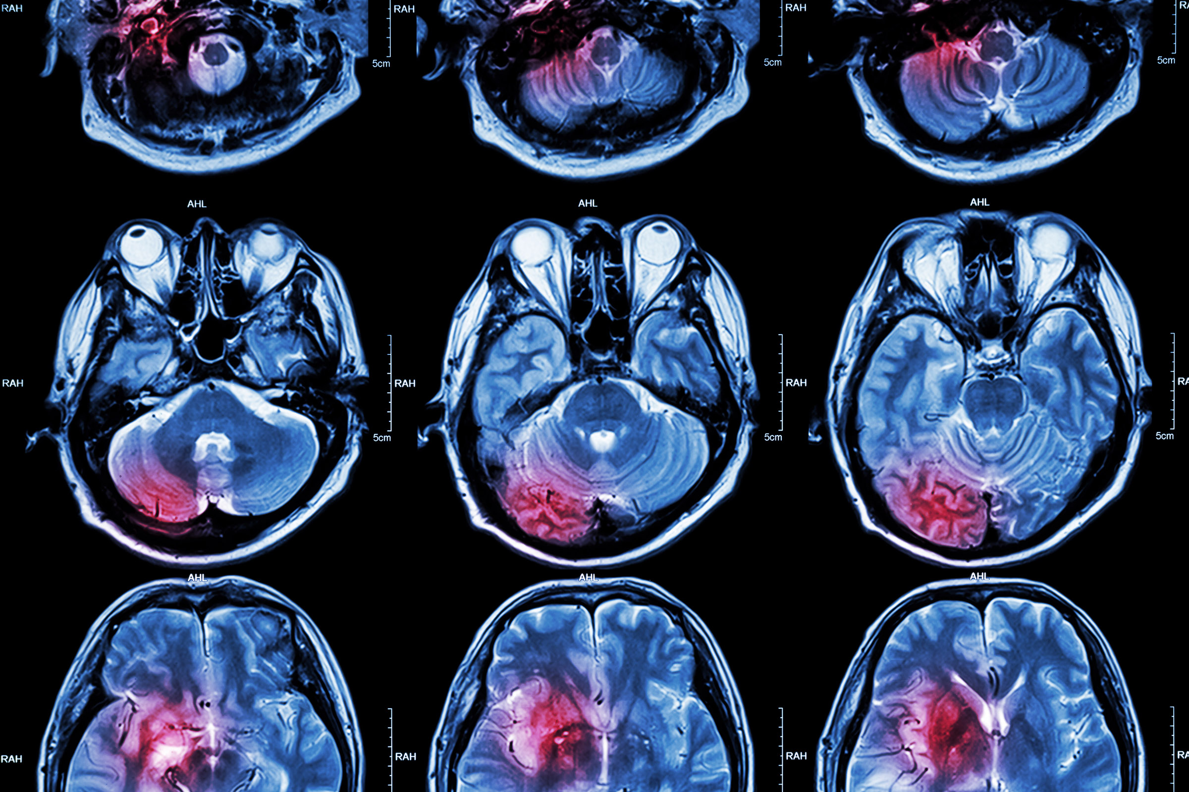 Film MRI, monitoring mysterious brain activity