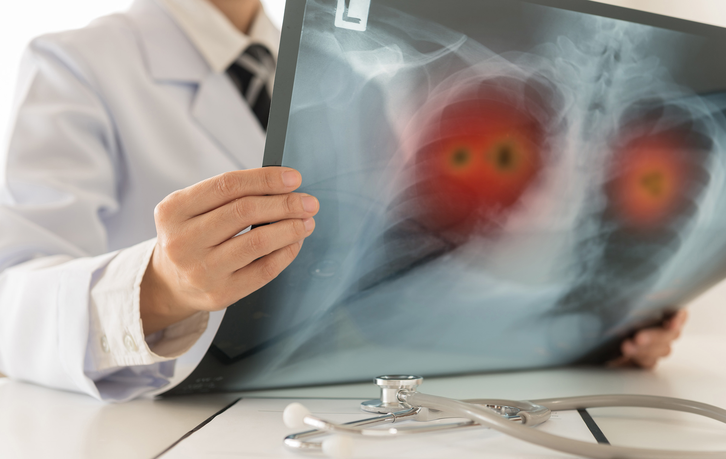 x-rays can help AI predict heart attack risk in patients over 10 years