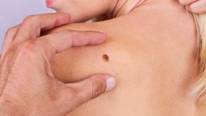 cancer-killing patch skin cancer could be cured with cancer-killing gel