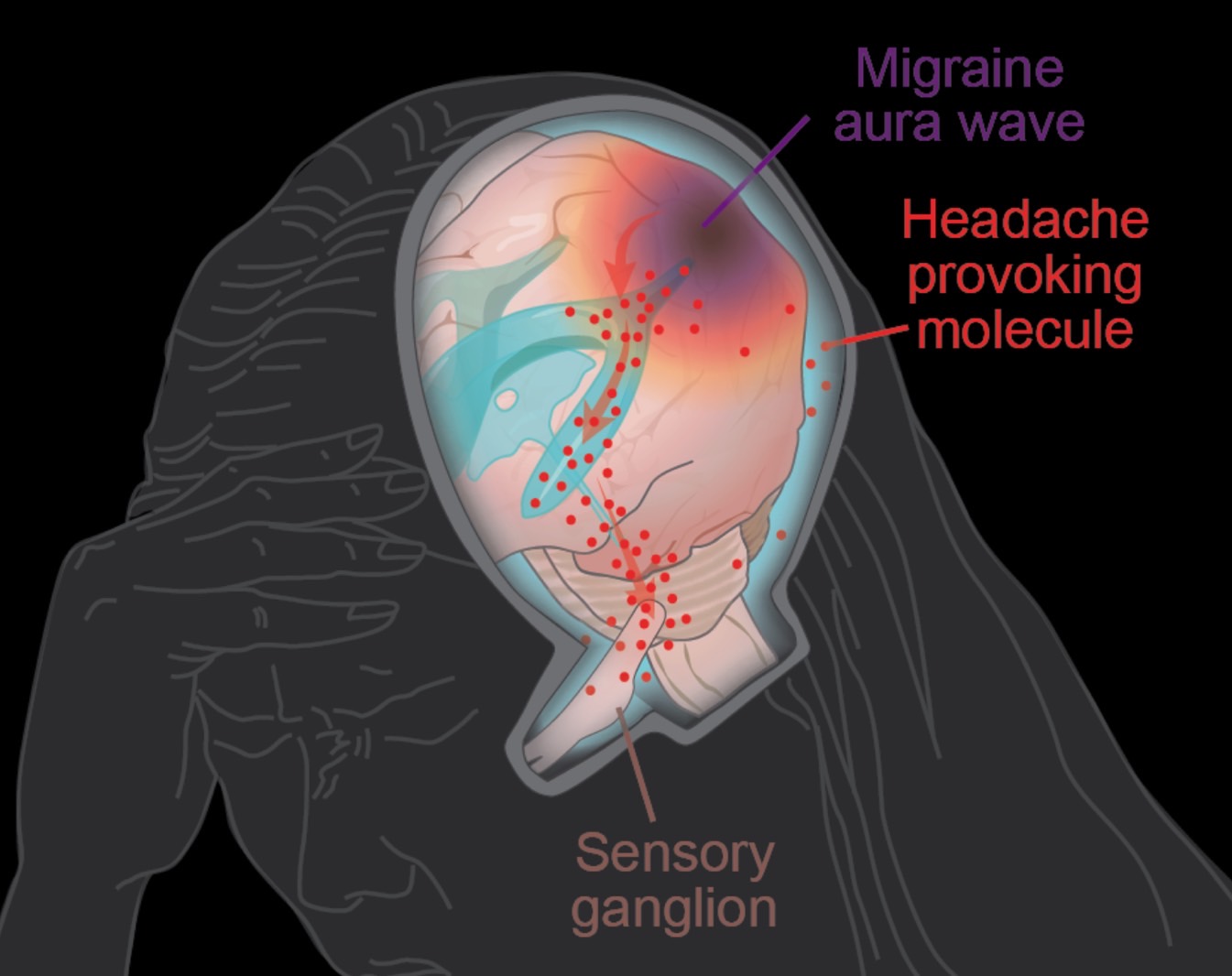 Study explains how headaches happen in migraines after the initial aura.
